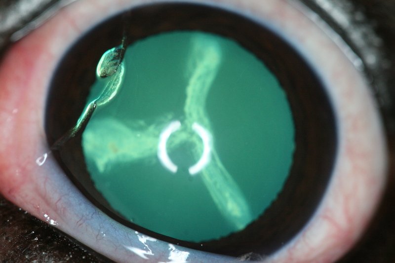 Luxation ou subluxation du cristallin